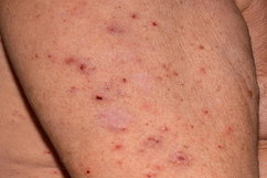 Illustrative image of the article Red Spots on Skin: 19 Common Causes & Treatments