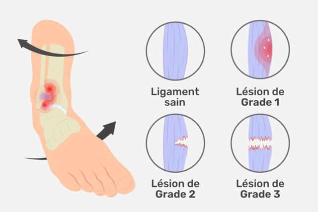 différents grades d'entorse