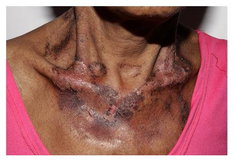 Illustrative image of the article Pellagra: Symptoms, Causes & Treatment