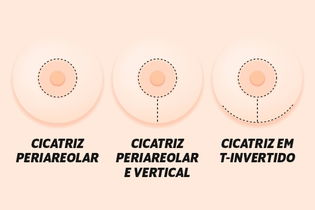 Imagem ilustrativa do artigo Mastopexia: o que é, quando é indicada e recuperação