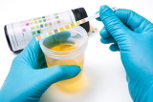 Image illustrative de l'article Cellules épithéliales dans l'urine: 4 causes (et que faire)