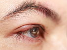 Illustrative image of the article Chalazion: Symptoms, Difference from Stye, Causes & Treatment