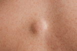 Image illustrative de l'article Lipome: symptômes, causes et traitement 