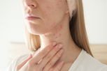 Illustrative image of the article Neck Acne: 10 Possible Causes (& How to Get Rid of It)