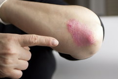 Illustrative image of the article Psoriasis Symptoms: 9 Signs, Types & Treatment