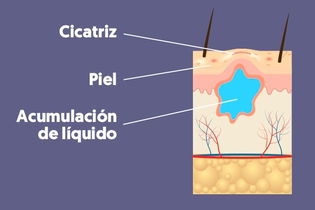 Imagen ilustrativa del artículo Seroma: qué es, síntomas y tratamiento