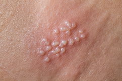 Imagen ilustrativa del artículo Cómo se contagia el herpes genital (y cómo evitarlo)
