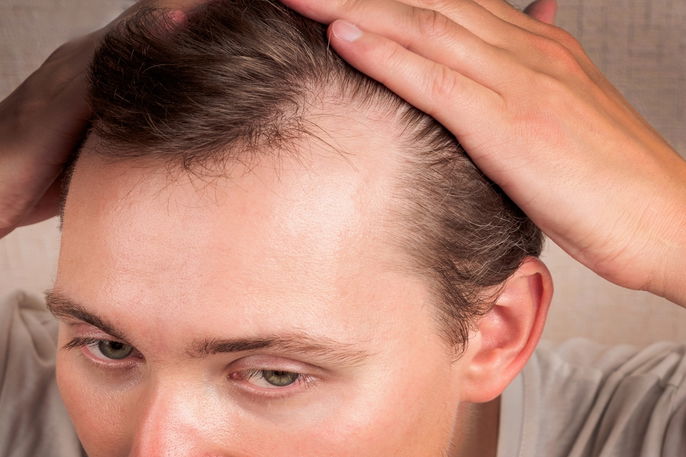 El hombre muestra pérdida de cabello