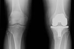 Imagen ilustrativa del artículo Prótesis de rodilla: qué es, tipos y cómo se realiza la operación