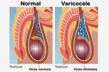 Illustrative image of the article Varicocele: Symptoms, Causes, Diagnosis & Treatment