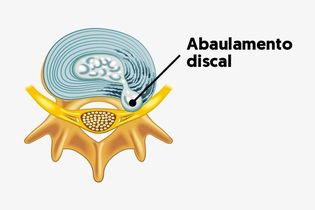 Imagem ilustrativa do artigo Abaulamento discal: o que é, sintomas, causas e tratamento