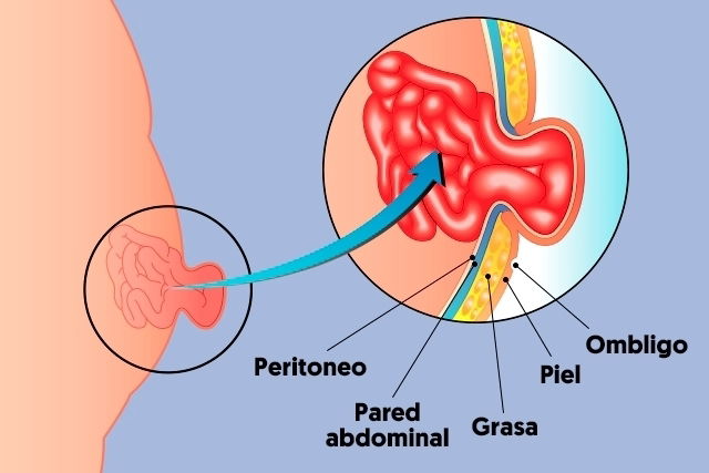 Imagen representativa de una hernia epigástrica