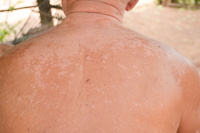 Pityriasis versicolor