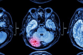 Imagem ilustrativa do artigo Como acontece a contusão cerebral