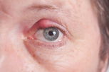 Illustrative image of the article Bump on Eyelid: 6 Possible Causes (& What to Do)