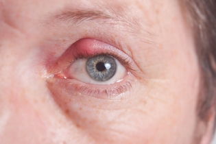 Illustrative image of the article Bump on Eyelid: 6 Common Causes & What to Do