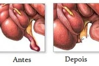 Imagem ilustrativa do artigo Apendicite aguda: o que é, sintomas, causas e tratamento