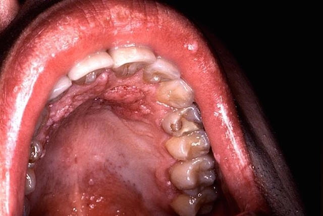 Síntomas de VPH en el hombre y en la mujer (con fotos) - Tua Saúde