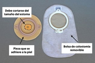 Imagen ilustrativa del artículo Colostomía: qué es, para qué sirve, cambio de la bolsa y cuidados