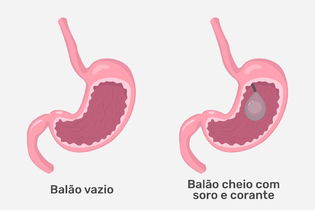 Imagem ilustrativa do artigo Balão gástrico: o que é, quando é indicado e como é colocado