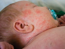 Illustrative image of the article Measles in Babies: Symptoms, Treatment & Prevention