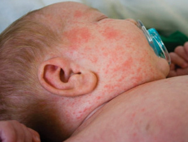 baby with measles rash