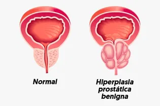 Imagen ilustrativa del artículo Hiperplasia prostática: qué es, síntomas, causas y tratamiento 