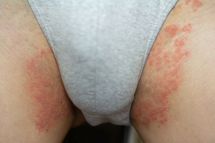 Intertrigo inguinal