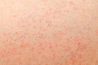 Illustrative image of the article Petechiae: When to Worry, What Causes Them & How to Treat