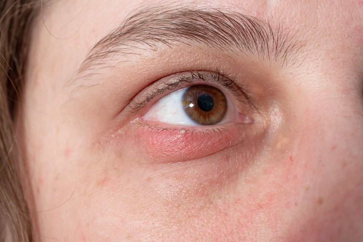 Bolita en el ojo: 6 causas y qué hacer - Tua Saúde