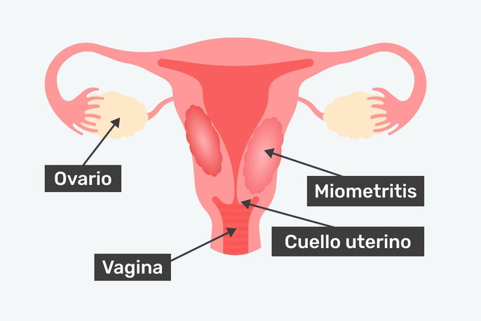 Útero con miometritis