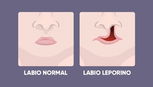 Imagen ilustrativa del artículo Lábio leporino: qué es, causas y tratamiento