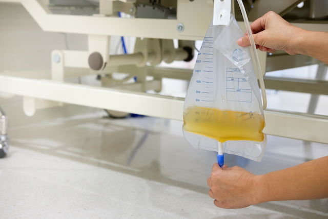 catheter bag with urine
