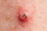 Illustrative image of the article Keratoacanthoma: Symptoms, Causes & Treatment