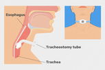 Illustrative image of the article Tracheostomy: Indications, Procedure & Care Tips