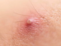 Illustrative image of the article How to Get Rid of a Boil: 6 Tips to Help It Heal Faster