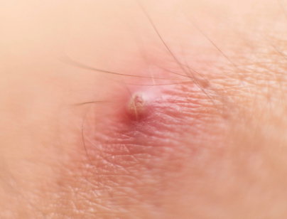 Illustrative image of the article How to Get Rid of a Boil: 6 Tips to Help It Heal Faster