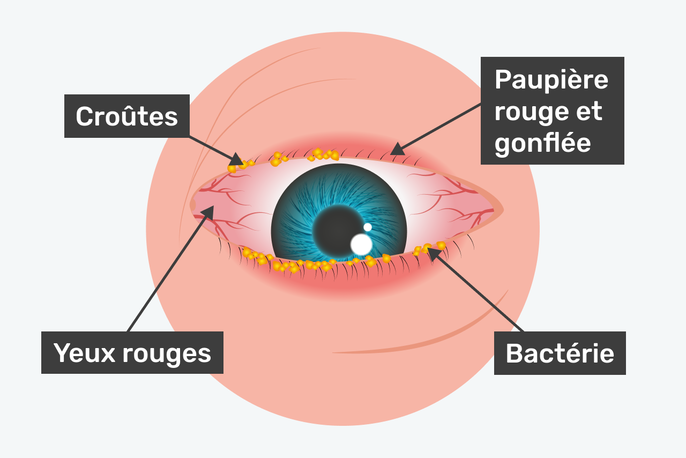 illustration de la blépharite