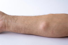 Illustrative image of the article Lipoma: Symptoms, Causes & Treatment