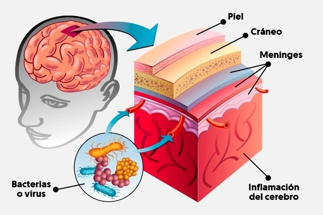 Imagen ilustrativa del artículo Meningitis: qué es, tipos y tratamiento