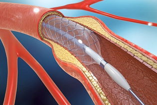 Imagem ilustrativa do artigo Stent: o que é, para que serve e principais tipos