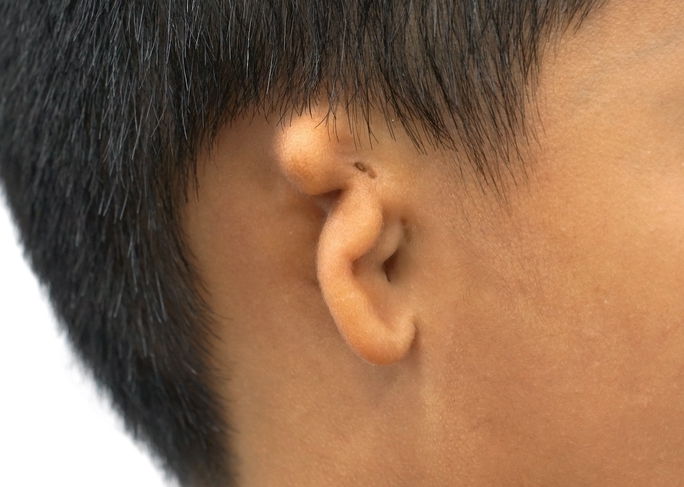 Microtia