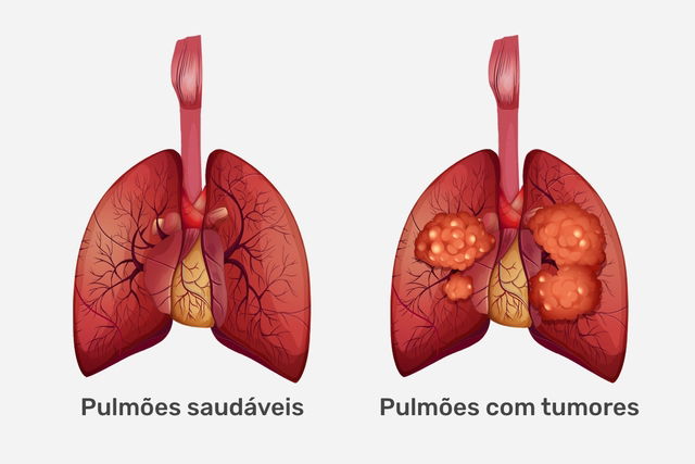 dessin illustratif des modifications pulmonaires en cas de cancer pulmonaire