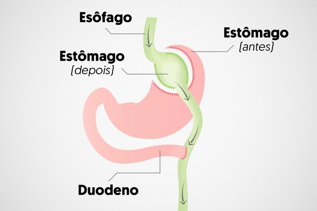 Bypass gástrico: o que é, como é feito, vantagens e desvantagens - Tua ...
