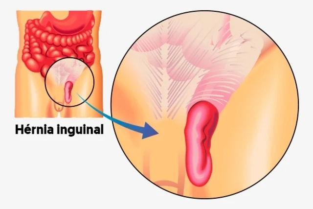 Hernia inguinal