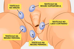 Imagem ilustrativa do artigo Criptorquidia: o que é, causas e tratamento