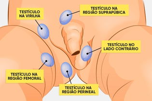 Imagen ilustrativa del artículo Criptorquidia: qué es, cómo identificar y tratamiento