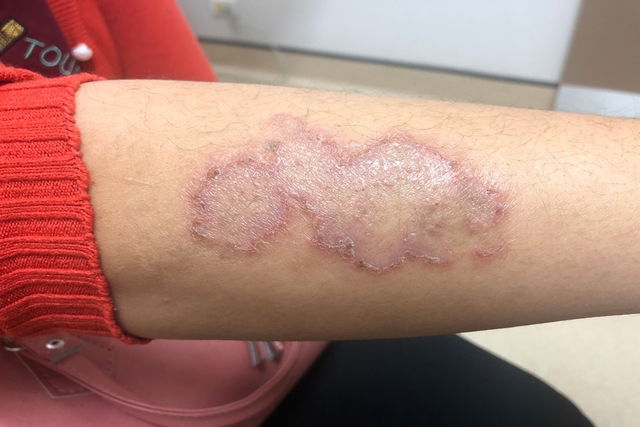 Lesão avermelhada no braço característica da impingem ou tinea corporis