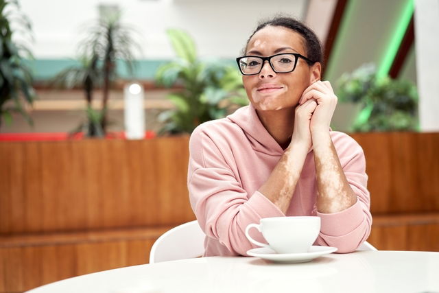 Mulher, com vitiligo, sentada à mesa