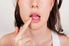 Illustrative image of the article Does anyone know how to get rid of a cold sore in 24 hours?